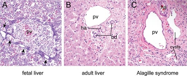 Histology_of_normal_and_defective_intrahepatic_bile_ducts.