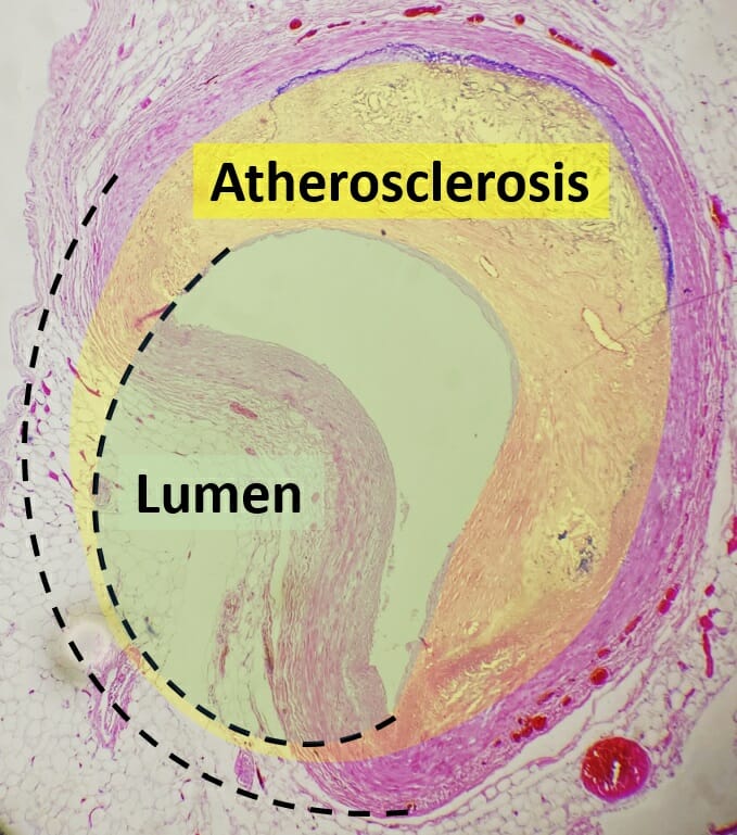 Histopathology of coronary artery atherosclerosis