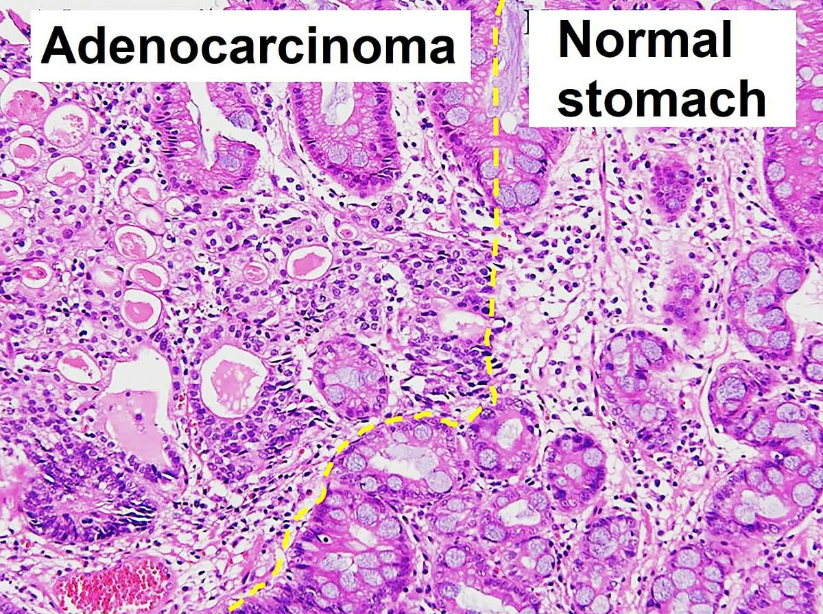 Histopathology of gastric adenocarcinoma and normal histology