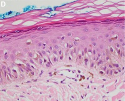 Histopatología del lentigo maligno