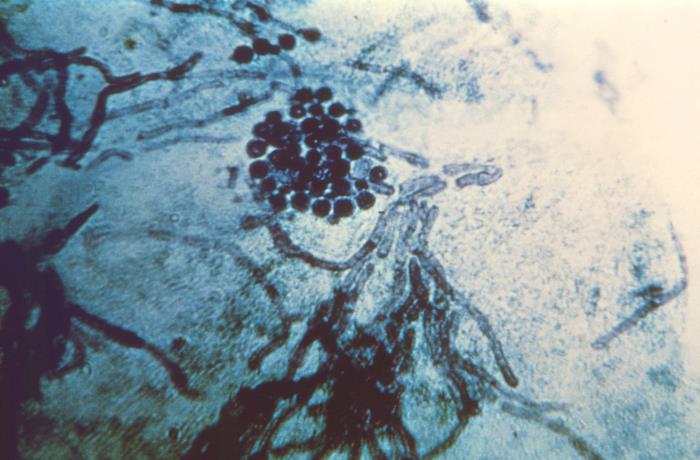 Histopathology of tinea versicolor