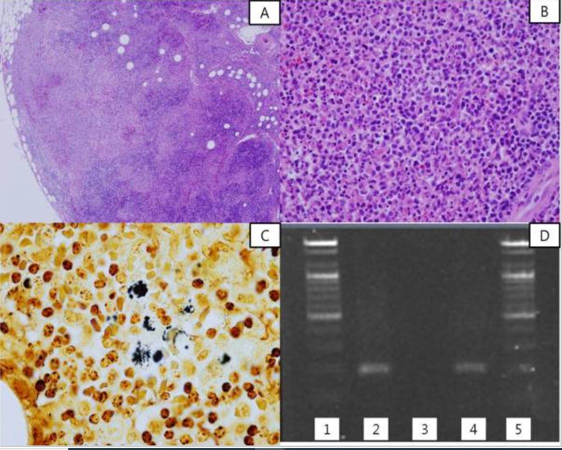 Histopathology, silver stain, and pcr of cat scratch disease