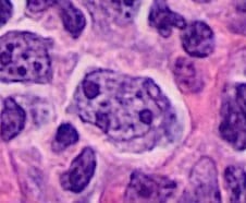 Histopathology of a centroblast in follicular lymphoma