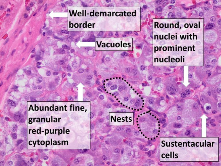 Pheochromocytoma | Concise Medical Knowledge