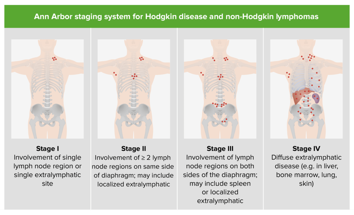Estadificación de la enfermedad de hodgkin