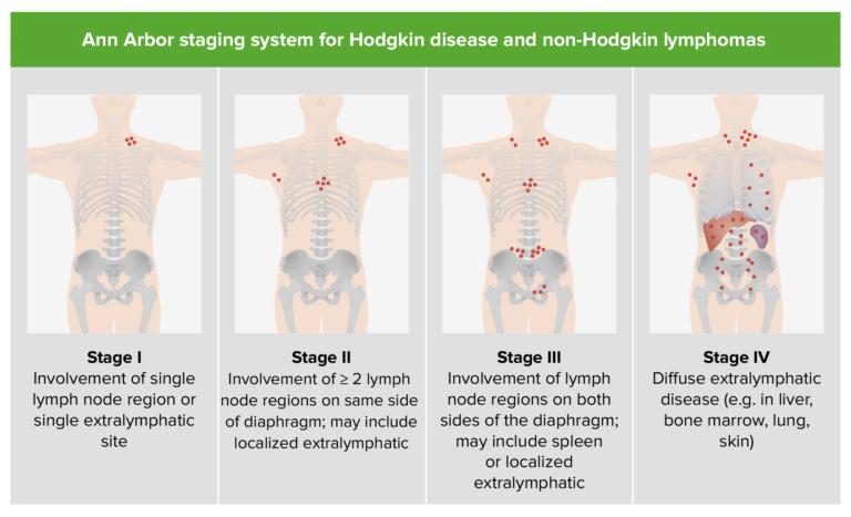 Linfomas No Hodgkin | Concise Medical Knowledge