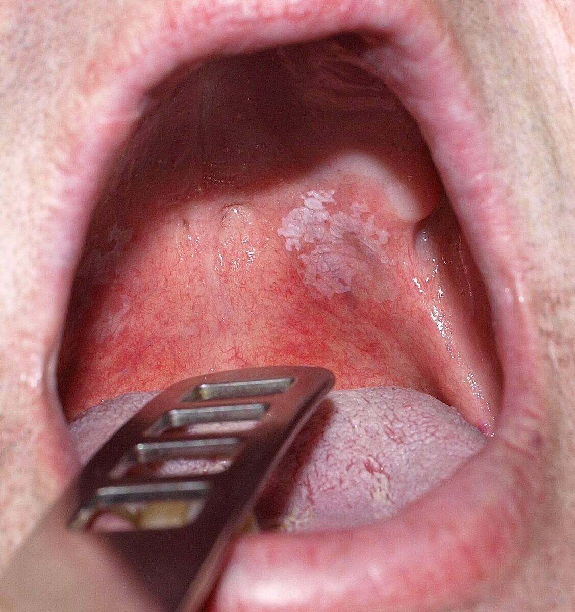 Homogenous oral leukoplakia