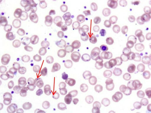 Howell-jolly bodies (red arrows) in circulating rbcs of an individual with overwhelming postsplenectomy infection (opsi)