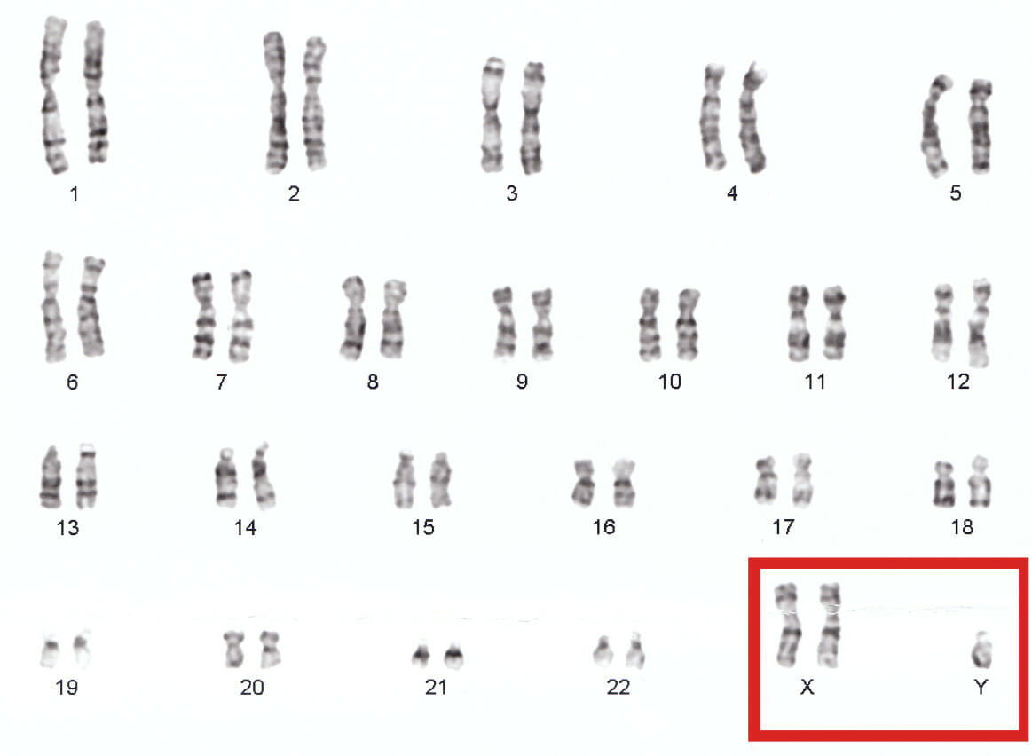 Human chromosomes xxy
