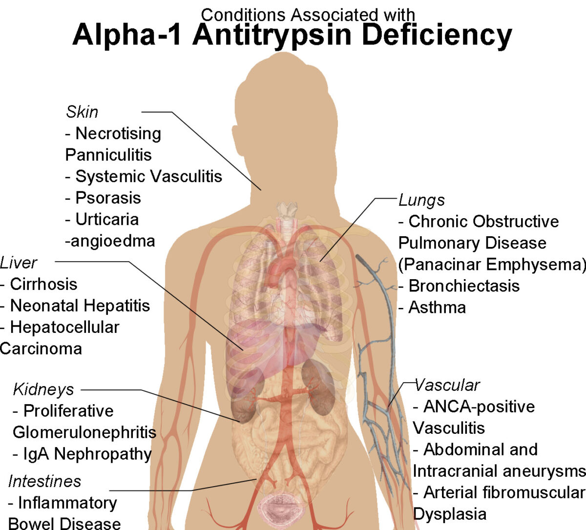 Human female shadow diagram with conditions associated with alpha-1 antitrypsin deficiency alpha-1 antitrypsin deficiency