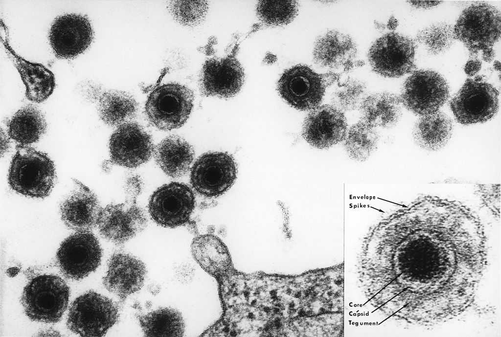 Human herpesvirus 6