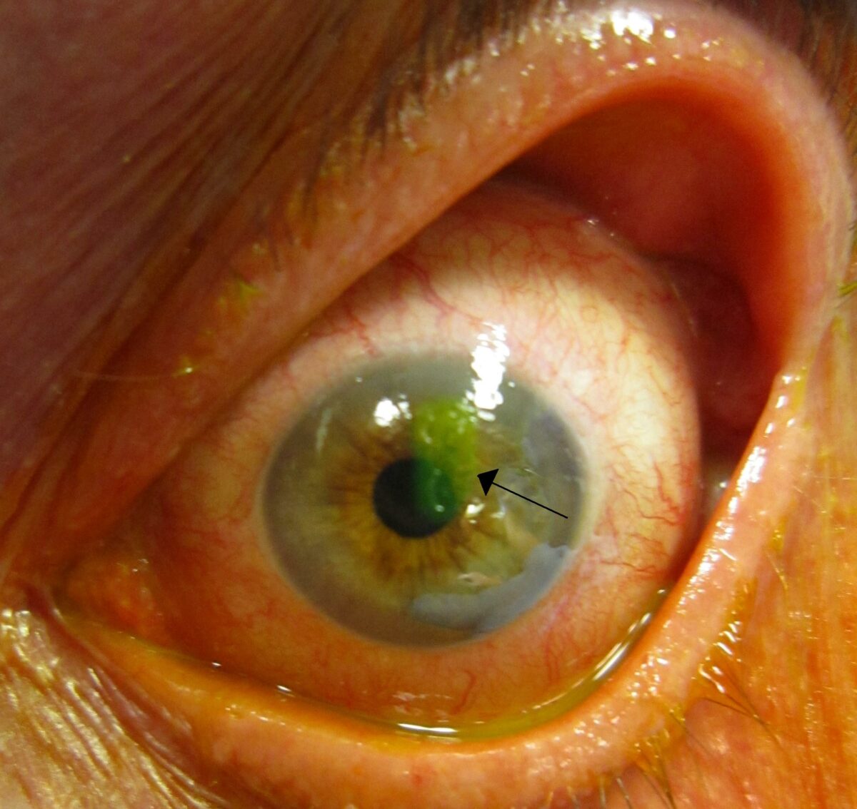 Human_cornea_with_abrasion_highlighted_by_fluorescein_staining