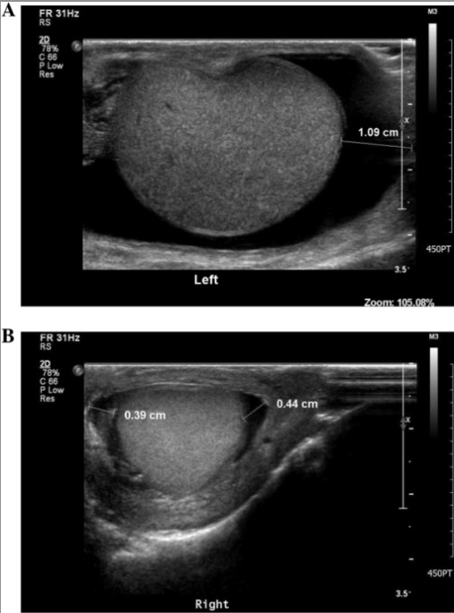 Varicocele, Hydrocele, and Spermatocele