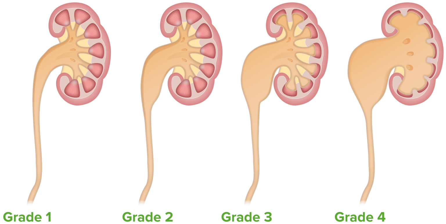 Hydronephrosis Concise Medical Knowledge