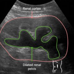 Hydronephrosis on renal ultrasound