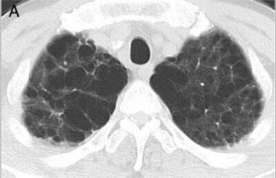 Imaging of the Lungs and Pleura | Concise Medical Knowledge
