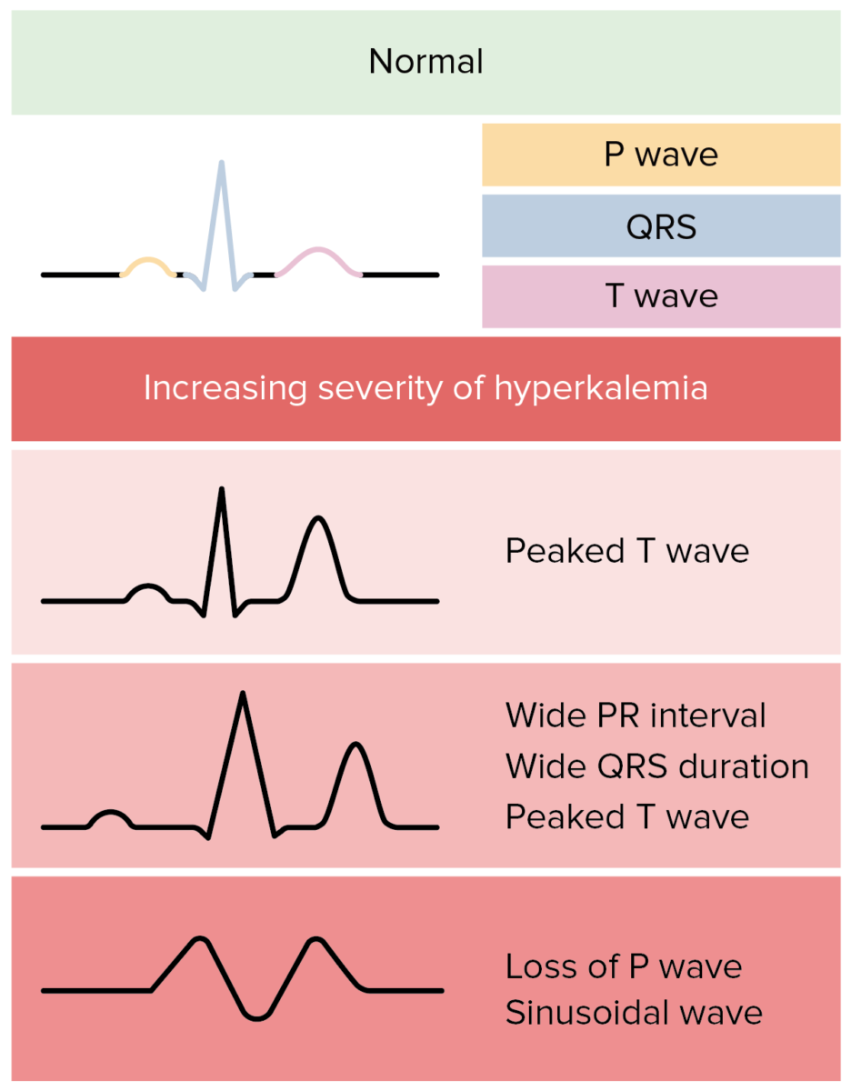 Onda T Apiculada Hipercalemia BRAINCP