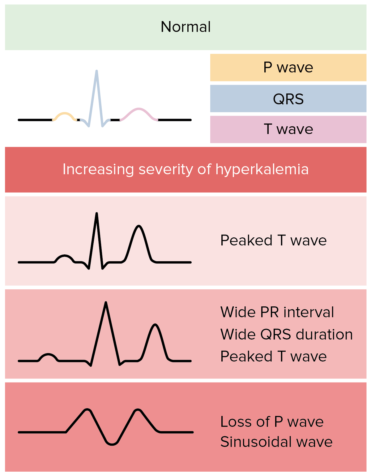 ecg signs of hyperkalemia