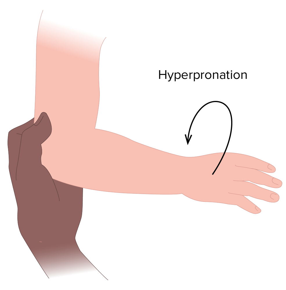 Hyperpronation technique