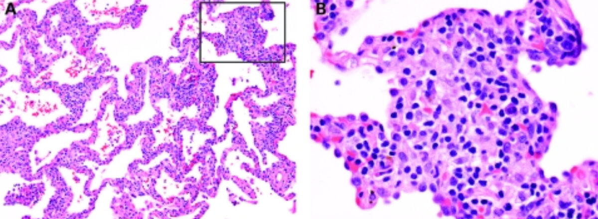 Biopsia de neumonitis por hipersensibilidad