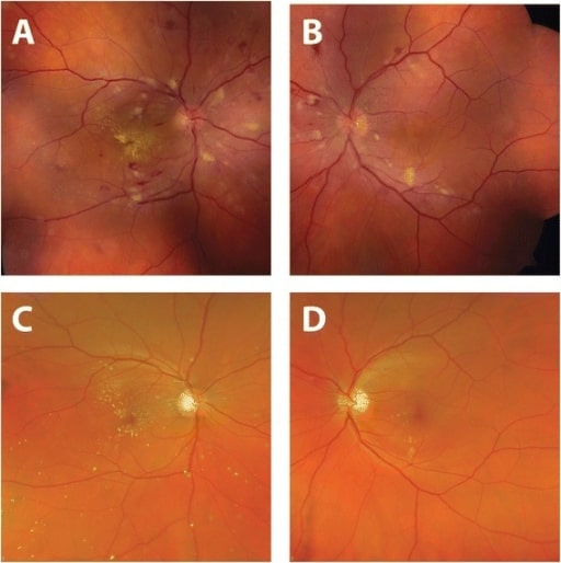 Hypertensive Retinopathy Concise Medical Knowledge