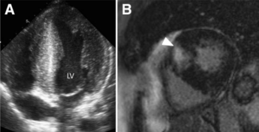 Hypertrophic cardiomyopathy shown on imaging