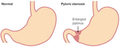 Hypertrophic Pyloric Stenosis | Concise Medical Knowledge