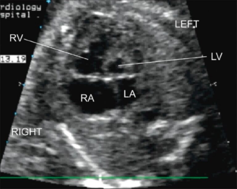 Hypoplastic Left Heart Syndrome Hlhs Concise Medical Knowledge