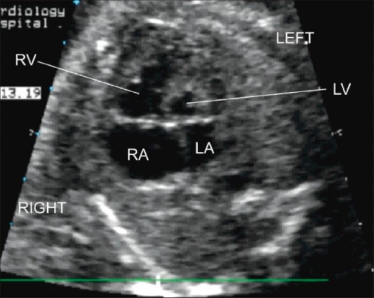 Hypoplastic Left Heart Syndrome (HLHS) | Concise Medical Knowledge