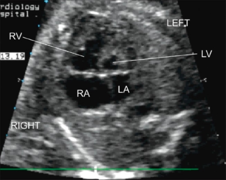Síndrome do coração esquerdo hipoplásico - ecocardiograma fetal
