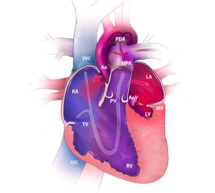 Hypoplastic left heart syndrome