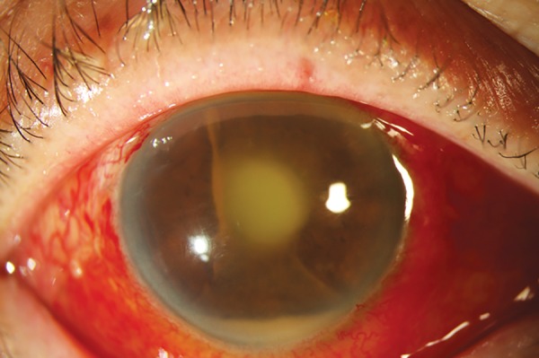 Hypopyon and track of pus with endophthalmitis associated with glaucoma shunt intraluminal stent exposure