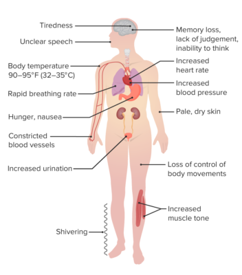 Hypothermia | Concise Medical Knowledge