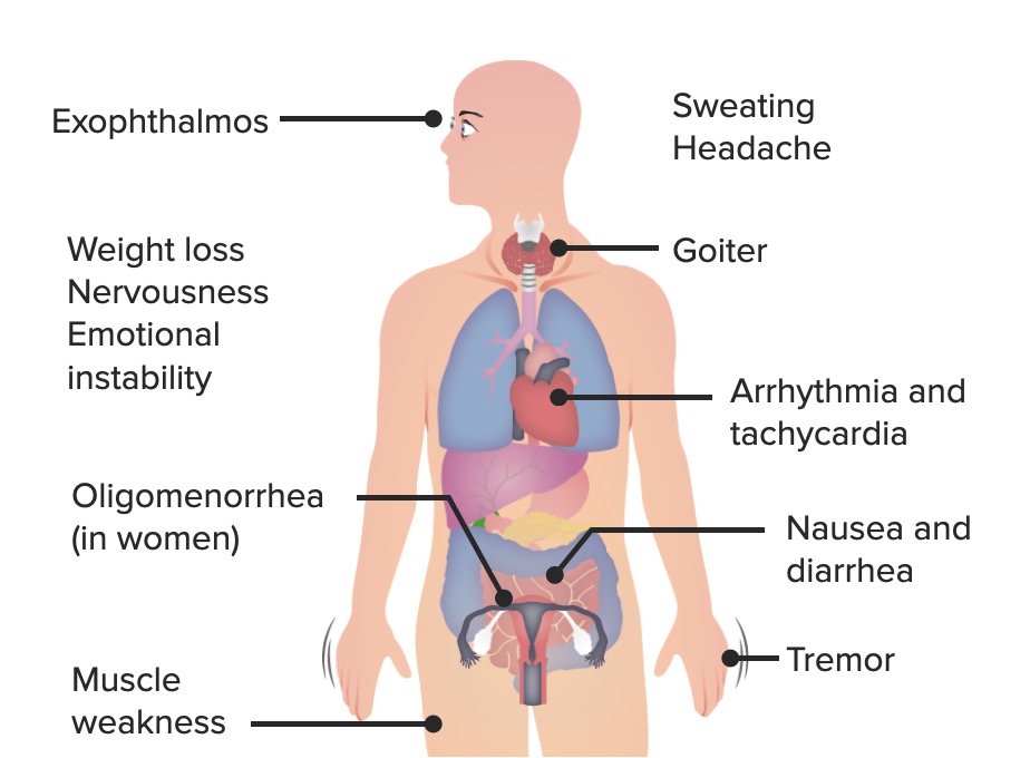 Sintomas de hipotiroidismo
