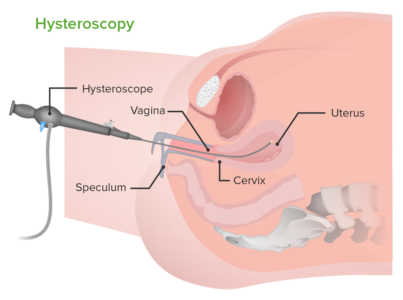 Hysteroscopy