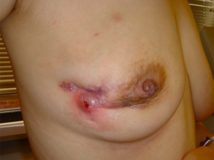 Mastitis granulomatosa idiopática de la mama derecha