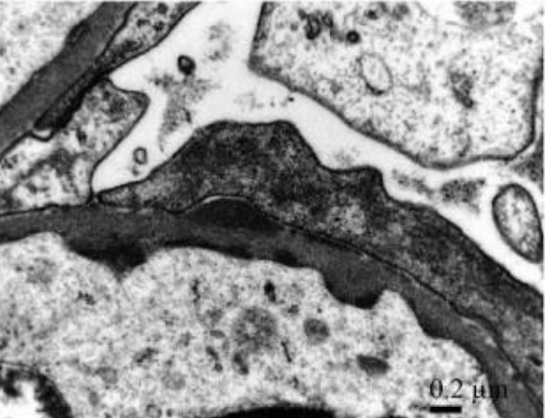 Iga-dominant acute poststreptococcal glomerulonephritis with concomitant rheumatic fever (electron micrograph)