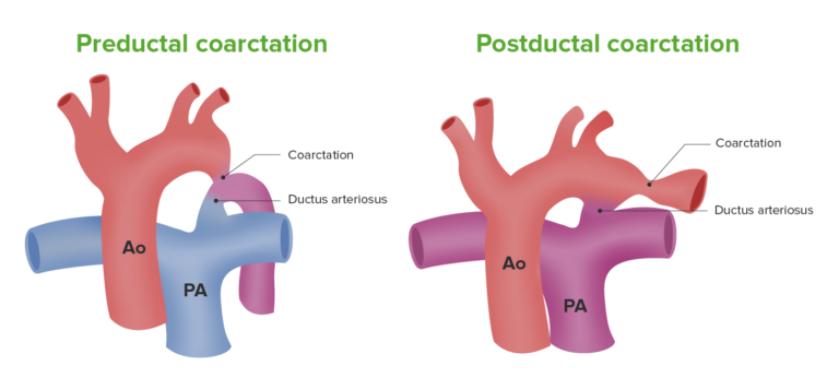 Coarctation Of The Aorta Concise Medical Knowledge   Illustration Coarctation Of Aorta 768x345 