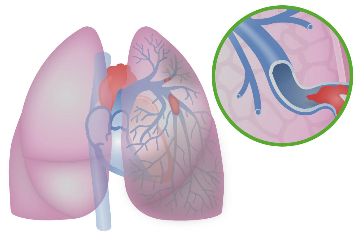Ilustración de una embolia pulmonar