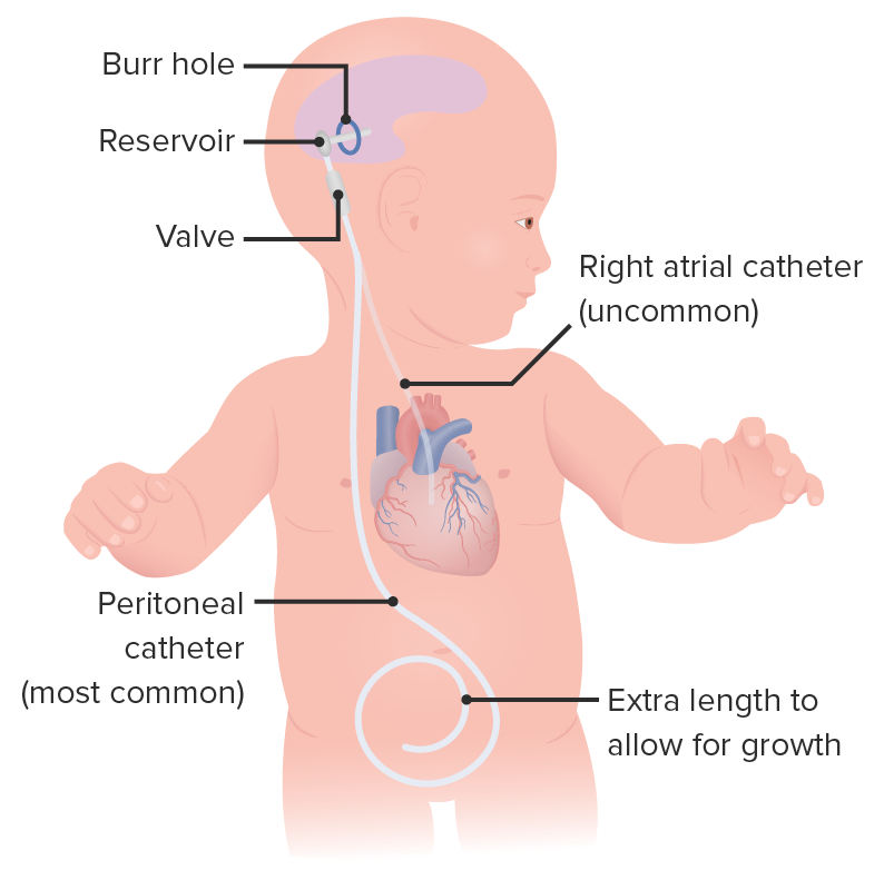 Ilustração de uma derivação ventriculoperitoneal num bebé.