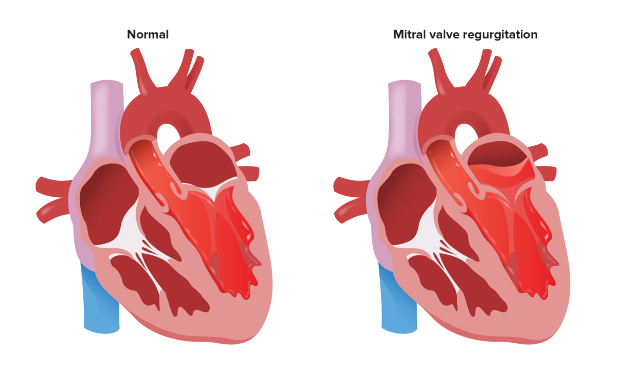 Ilustración de insuficiencia mitral