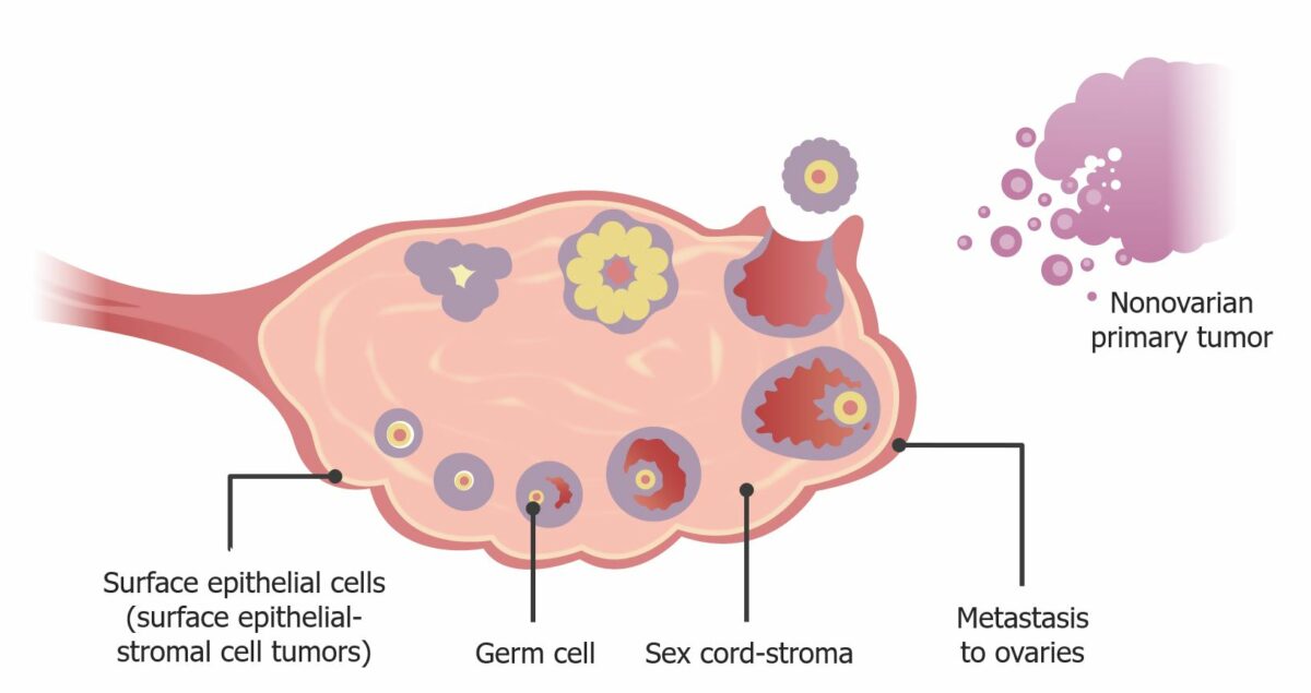 Image depicting the different types of ovarian cancer and their location of origin