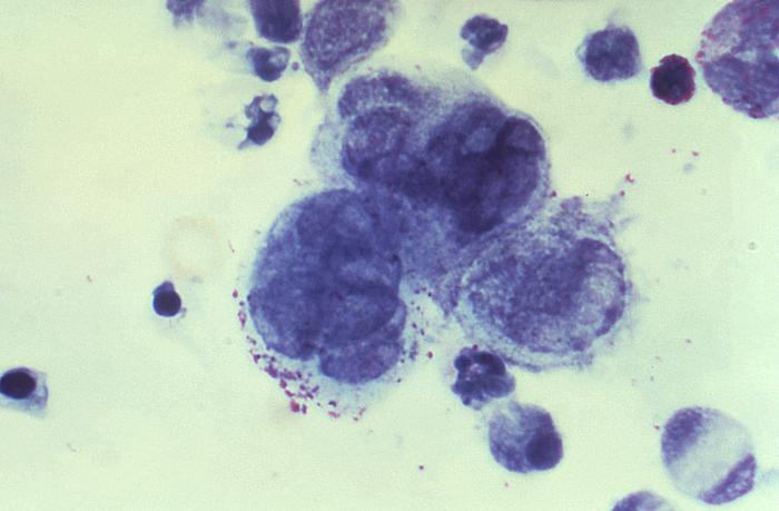 Imagem de um esfregaço de tzanck vírus herpes simplex