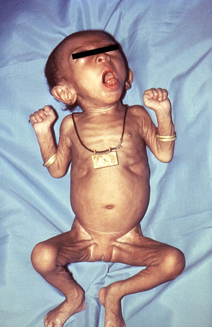 Image of a baby with pertussis