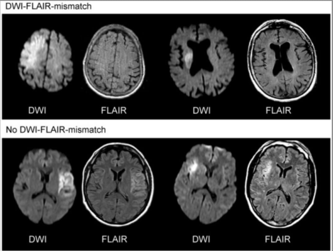 Imaging approach to identify patients with “wake-up stroke” who are likely to benefit from thrombolysis