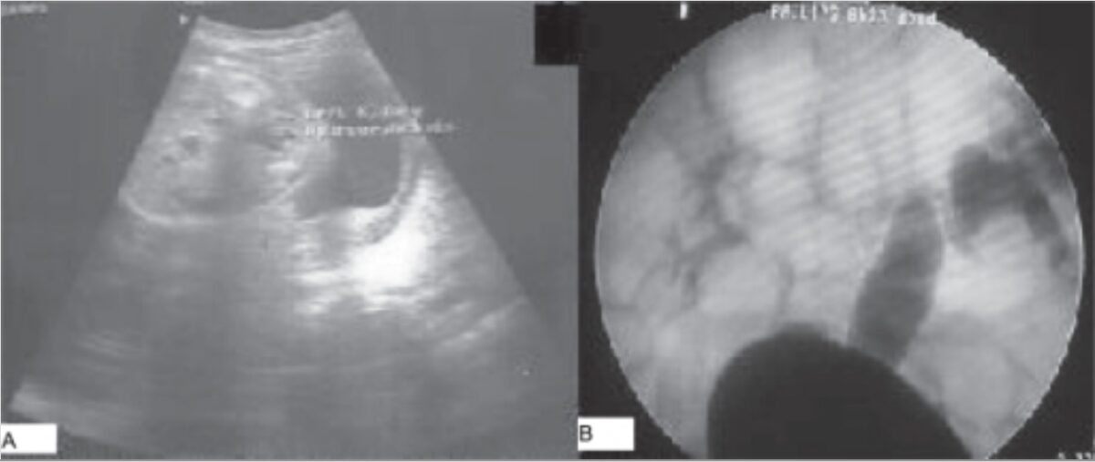 Imaging findings in vesicoureteral reflux