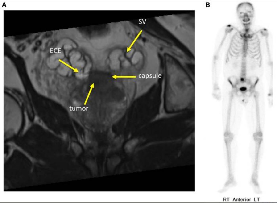 Imaging of a patient with metastatic prostate cancer