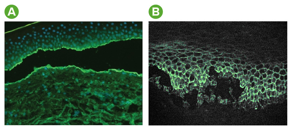 mucous membrane pemphigoid histology