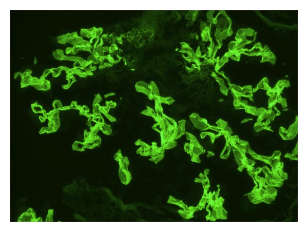 Immunofluorescence staining shows linear anti-gbm igg deposition consistent with goodpasture syndrome
