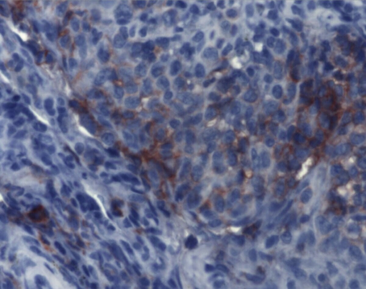 Imuno-histoquímica da histiocitose de células de langerhans